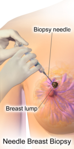 biopsy